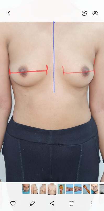 Breast Implant KOQ10